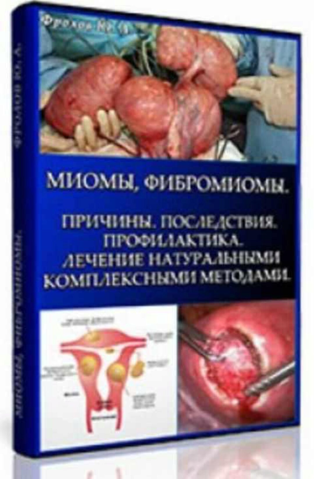 Миомы, Фибромиомы. Причины, мини инфопродукт №7 (Юрий Фролов)