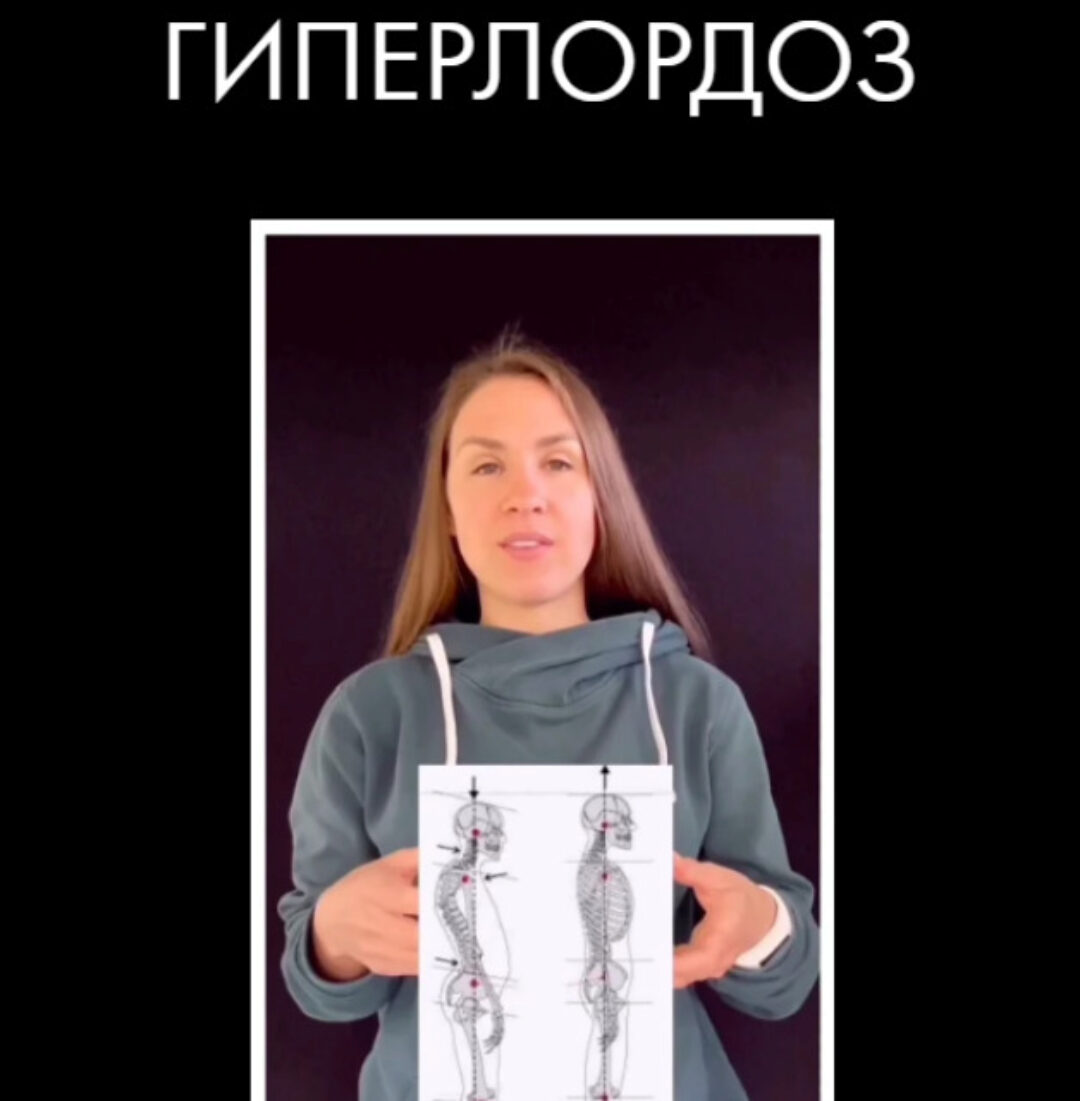 Гиперлордоз (Христина Жарикова)