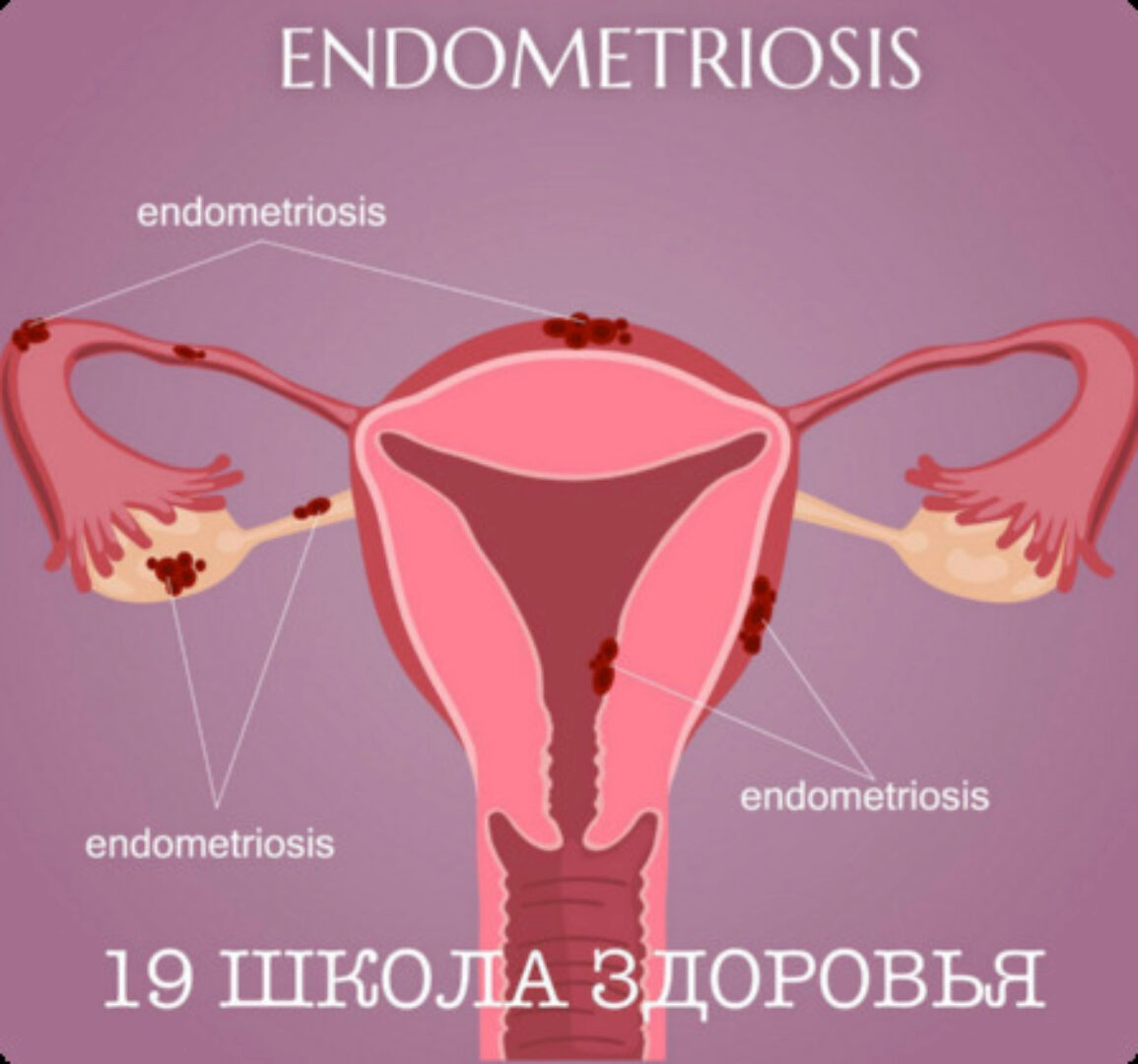 19 школа здоровья. Эндометриоз. Базовый (Гала Гарбузова)