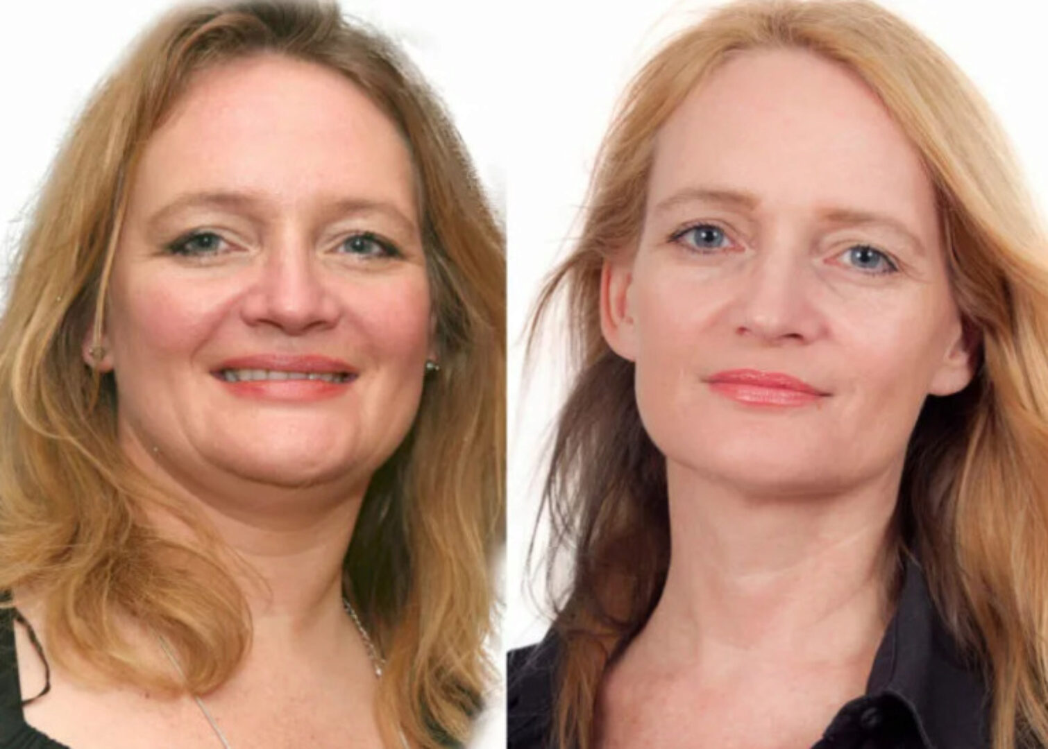 Гипотиреоз (Катя Янг)