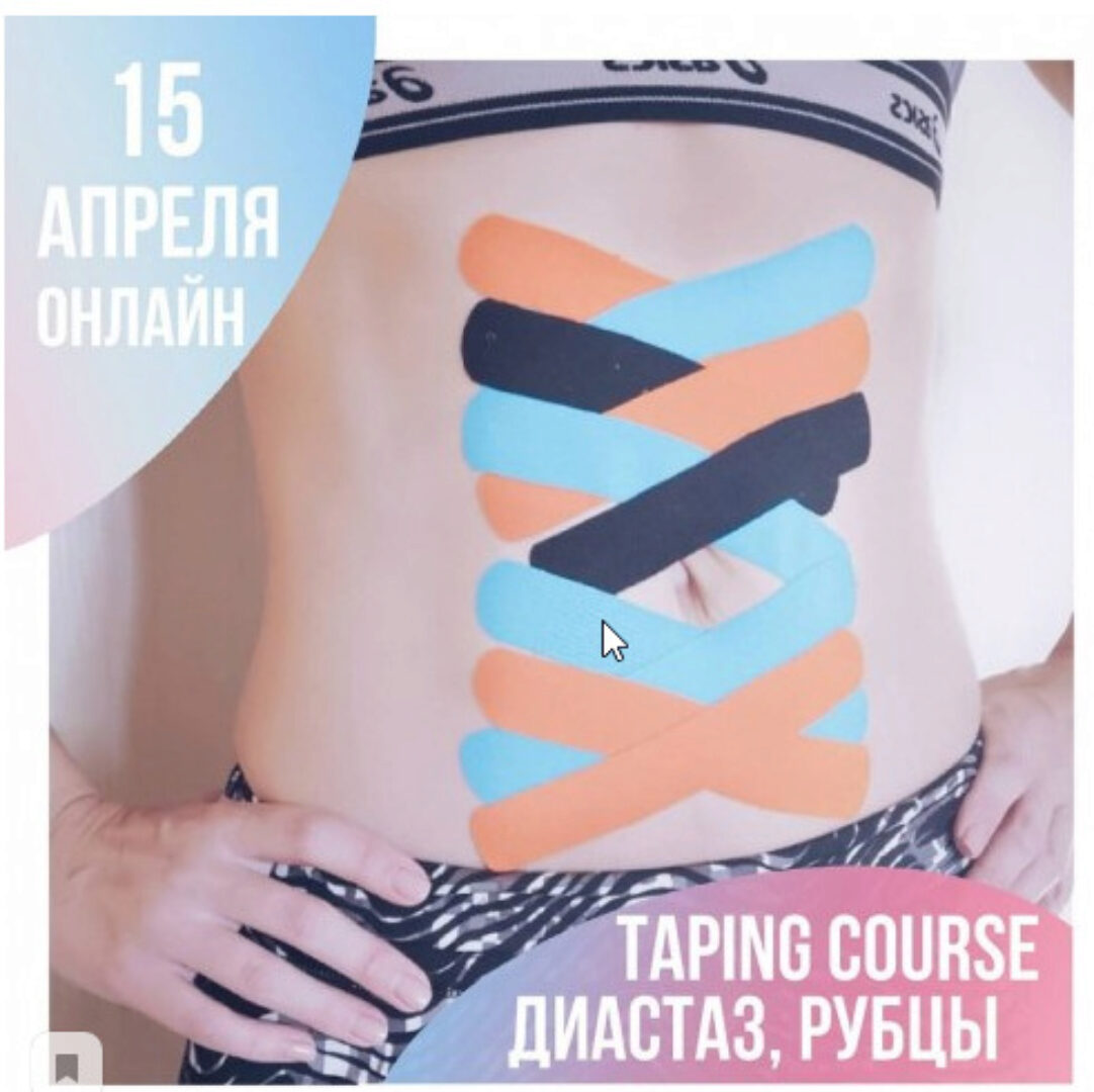Диастаз, рубец, слабость пупочного кольца (грыжа). Тейпирование (Екатерина Невзорова / mavikatte)