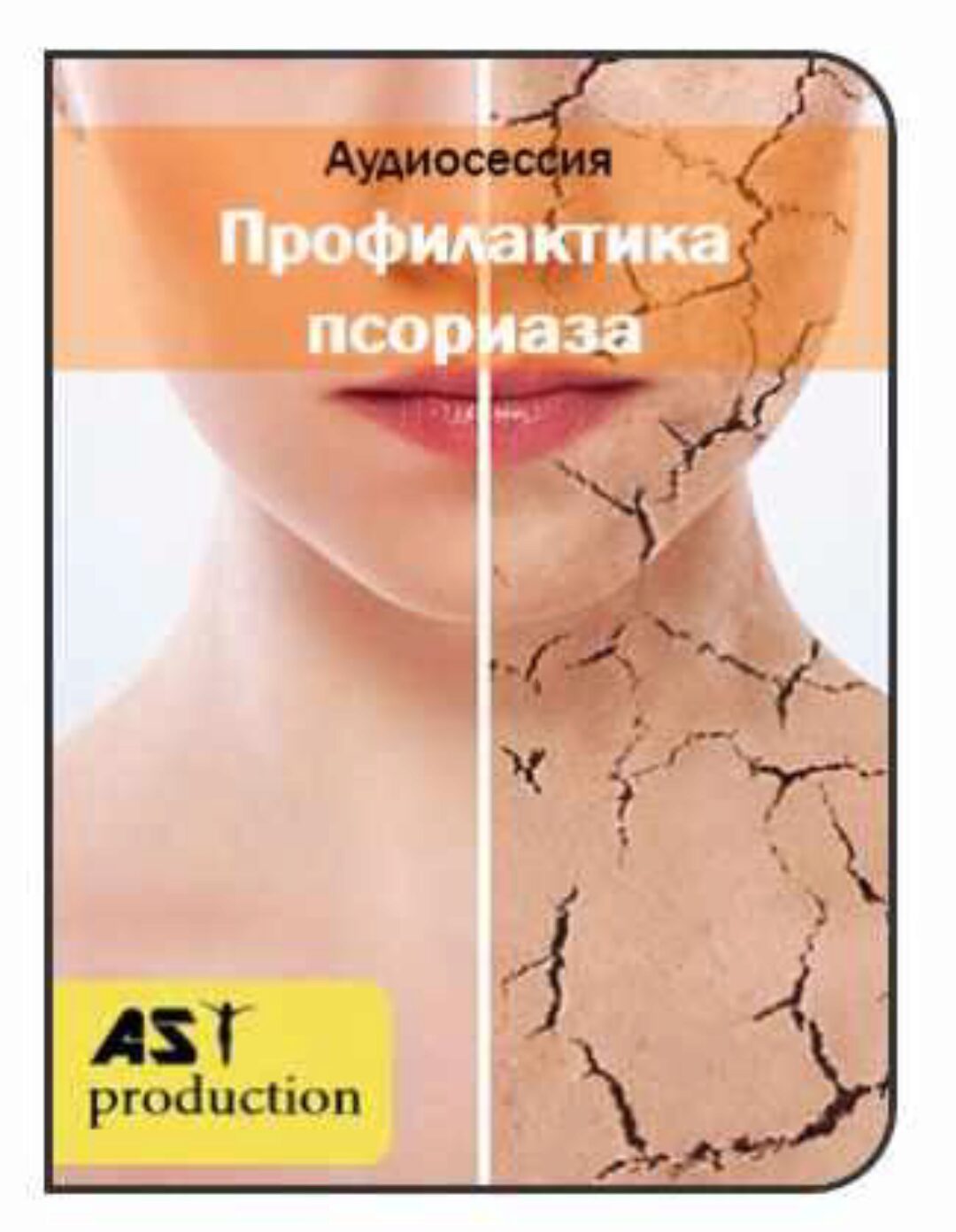 [AST-production] Профилактика псориаза