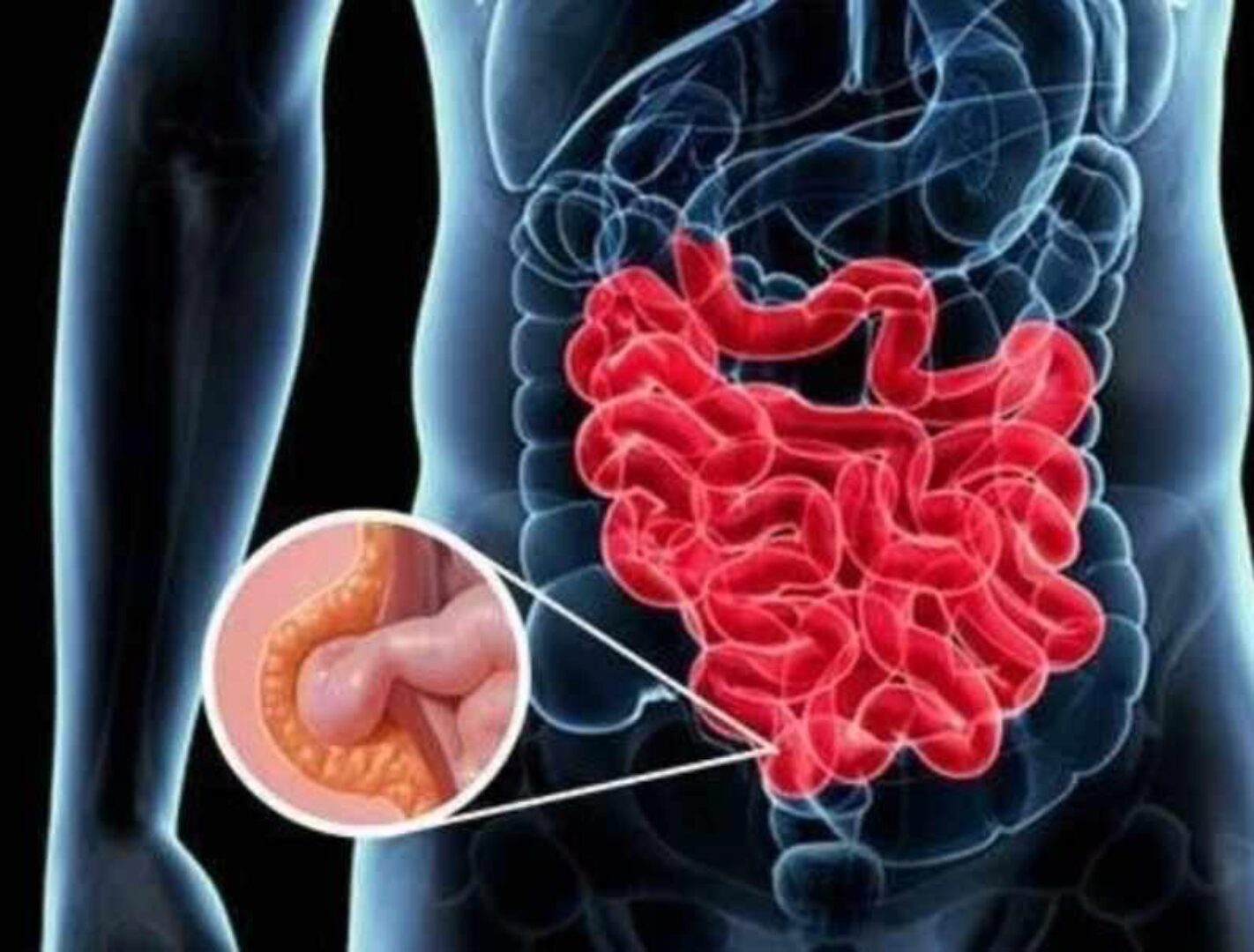 [Sigh Energy] Лечение грыжи