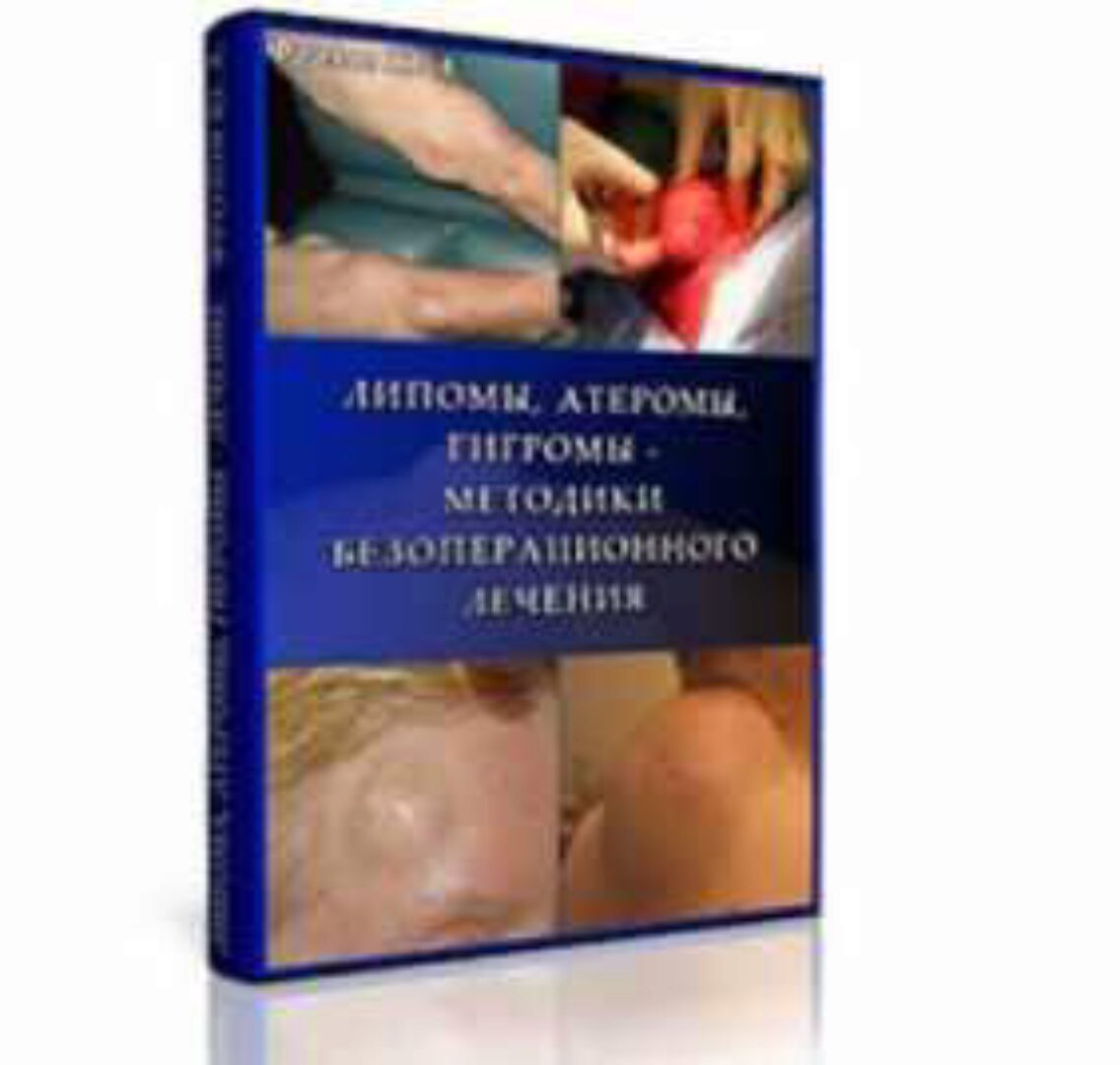 Липомы, Атеромы, Гигромы — Методики безоперационного лечения, Мини инфопродукт №6 (Юрий Фролов)