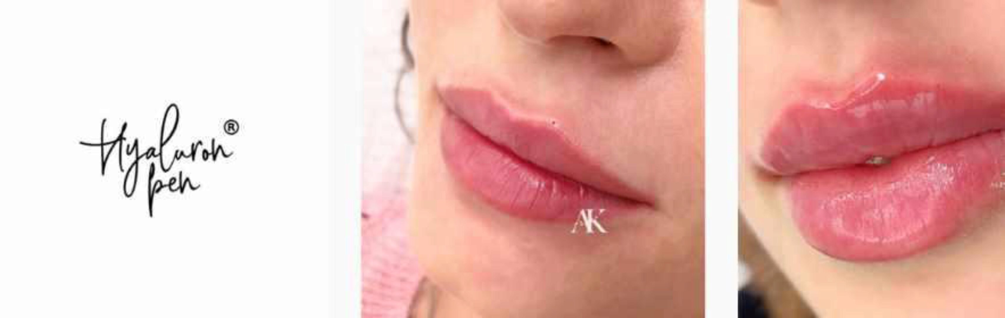 Полный курс Hyaluron Pen (гиалурон пен) Все методики контурной пластики (Алина Каратаева)