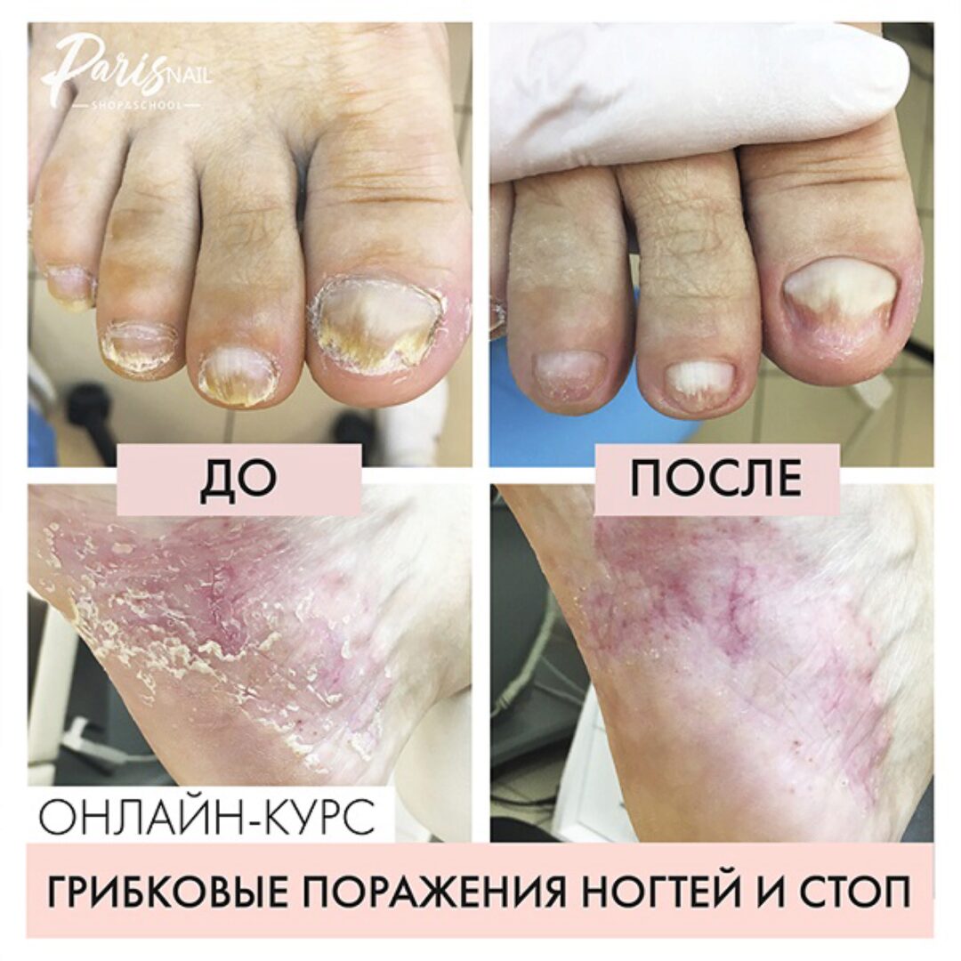 [parisnail] Грибковое поражение ногтей и кожи стоп (Карина Шурыгина)