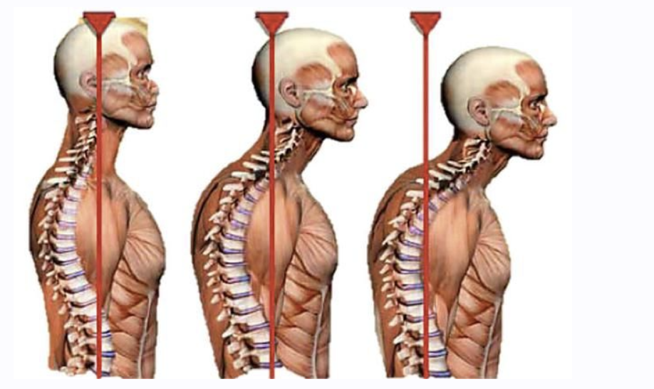 Практические примеры коррекции осанки и фигуры в сагиттальной плоскости (Александр Волоткевич)