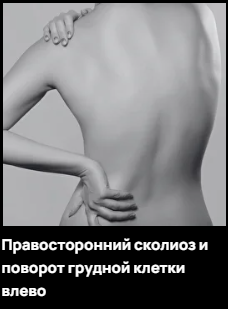 Правосторонний сколиоз и поворот грудной клетки влево (Александр Волоткевич)